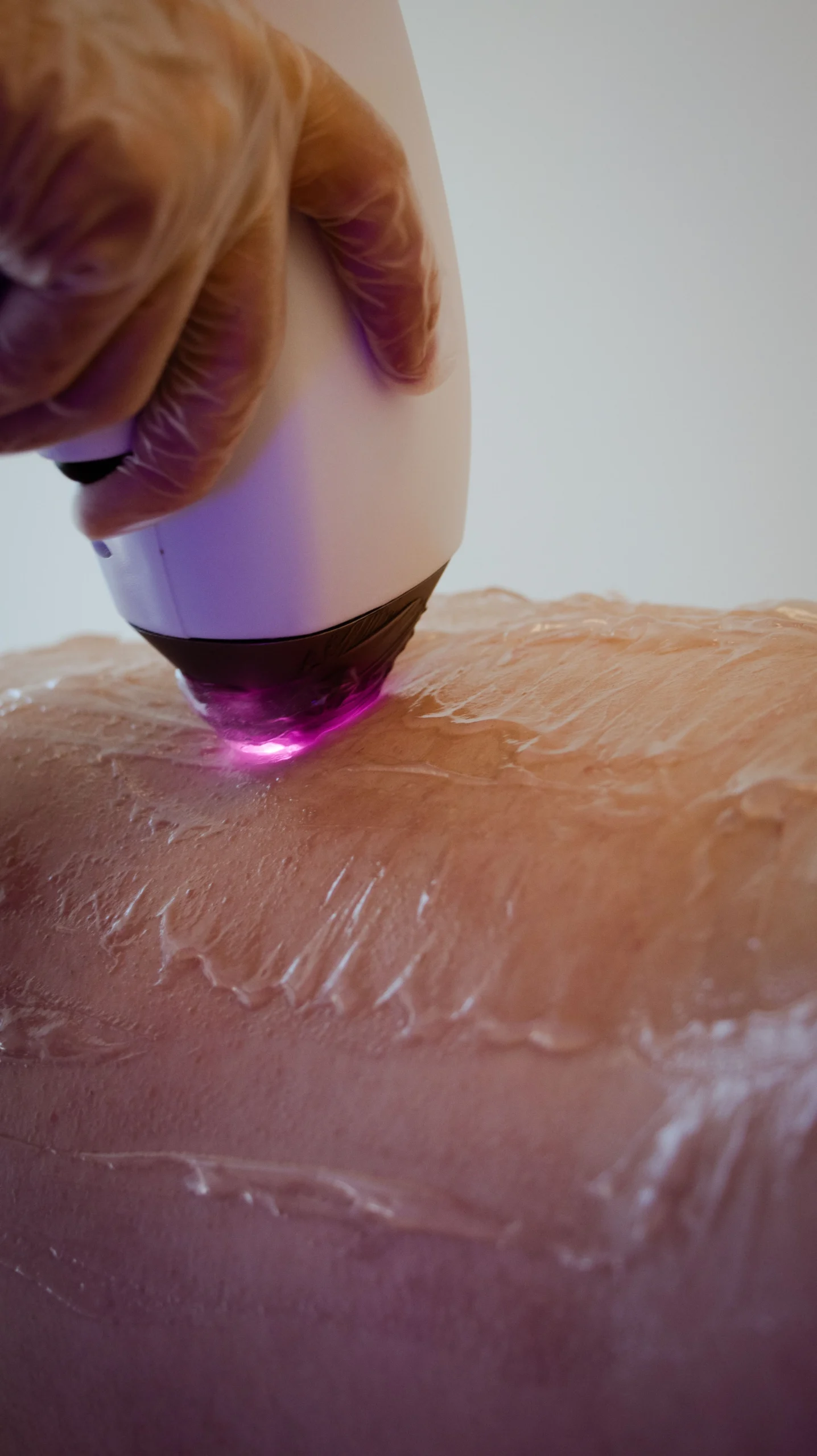 Epilazione definitiva con luce pulsata